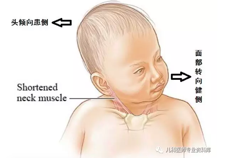 宝宝脖子出现这种情况时，家长越早干预越好
