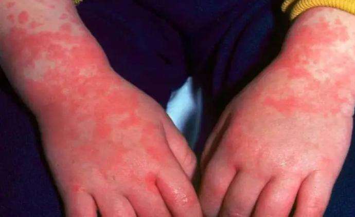 每个孩子都会得幼儿急疹吗？