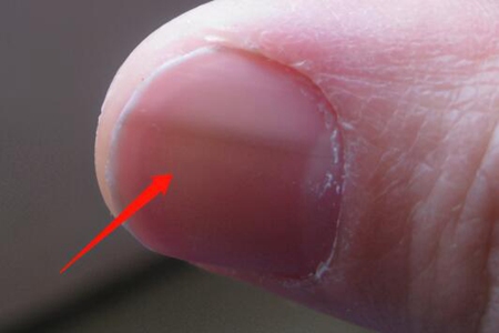 指甲有竖纹什么原因？这五个症状引发及时治疗改善